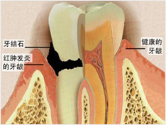 牙周病综合治疗优势