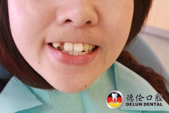 牙列不齐