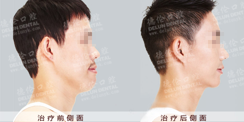 反颌矫正案例 大叔变身帅气男篮