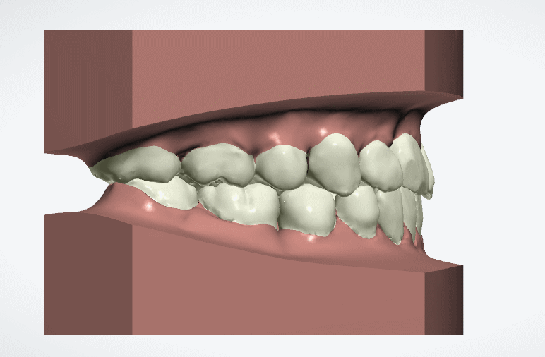 德伦口腔数字化正畸技术,在不损害牙齿及其周围组织