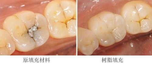 补牙大概要多少钱
