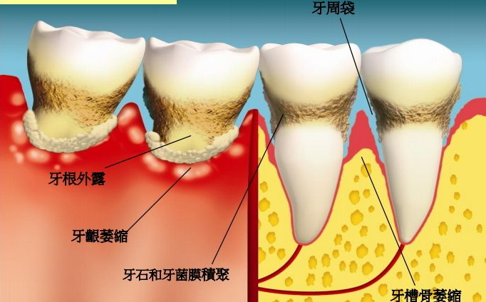 的是牙周组织发生炎症, 如果不及时治疗的话,炎症会进一步扩散到牙龈