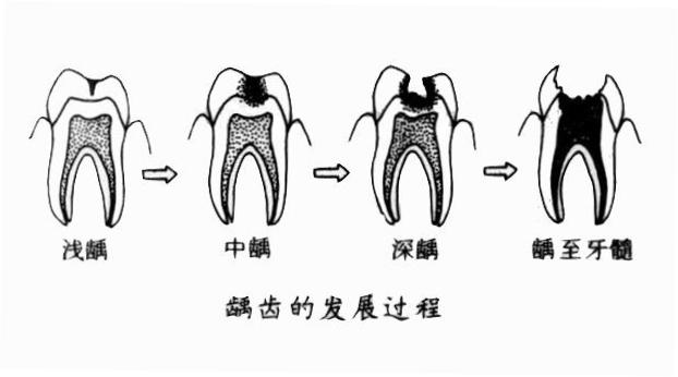 儿童出现龋齿有什么症状?