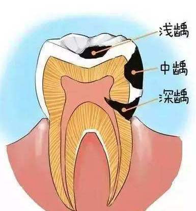 虫牙也就是我们常说的蛀牙(又称为龋齿),蛀牙的发生几率是非常