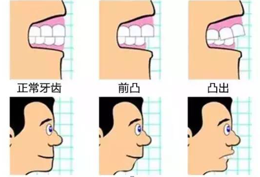 牙齿不齐可以不做矫牙吗?