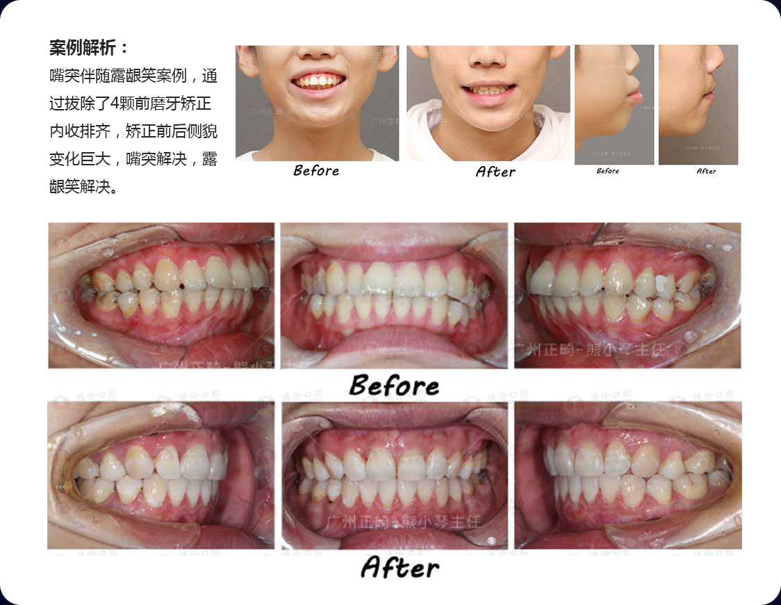 上海牙齿矫正 丨 深覆合不拔牙方案实现侧脸逆袭！ - 知乎